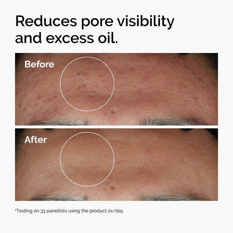 The Ordinary Niacinamide 10% + Zinc 1% Serum (30ml) – Oil Control & Pore Refining Treatment